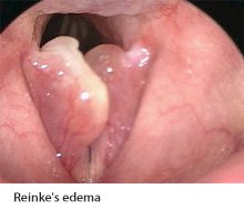 mp_mok_p_edema