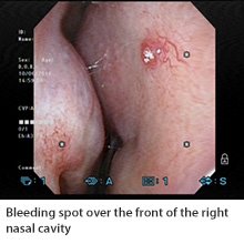 ENT Specialist Singapore  The Cons Of Nose Picking