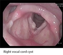 mp_mok_p_vocal_cord_cyst